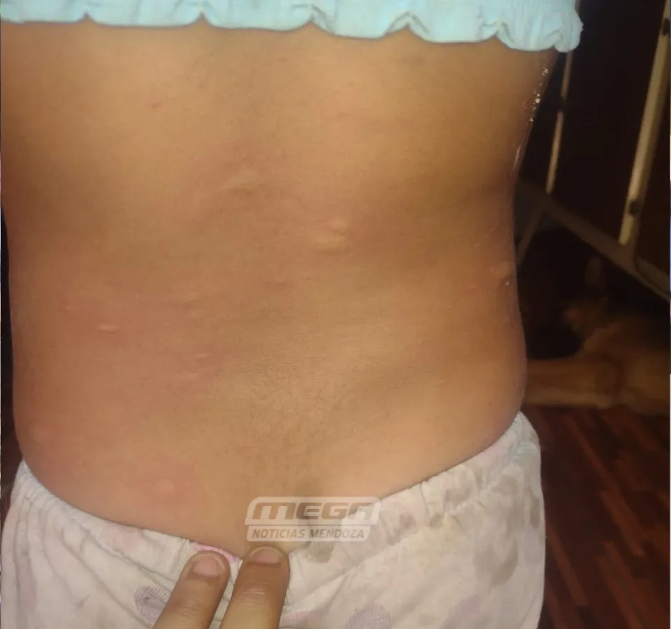 picadura de mosquito
